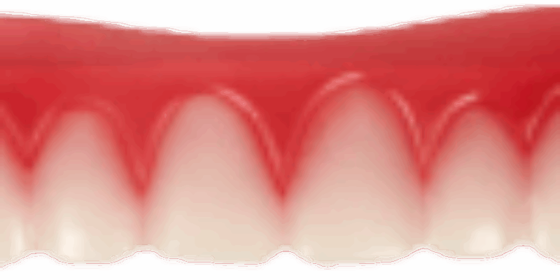 Виниры для зубов Perfect Smile Veneers — реальный способ обрести красивую улыбку!